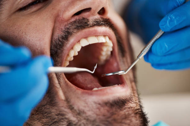 Best Emergency Wisdom Teeth Removal in Arden Hills, MN